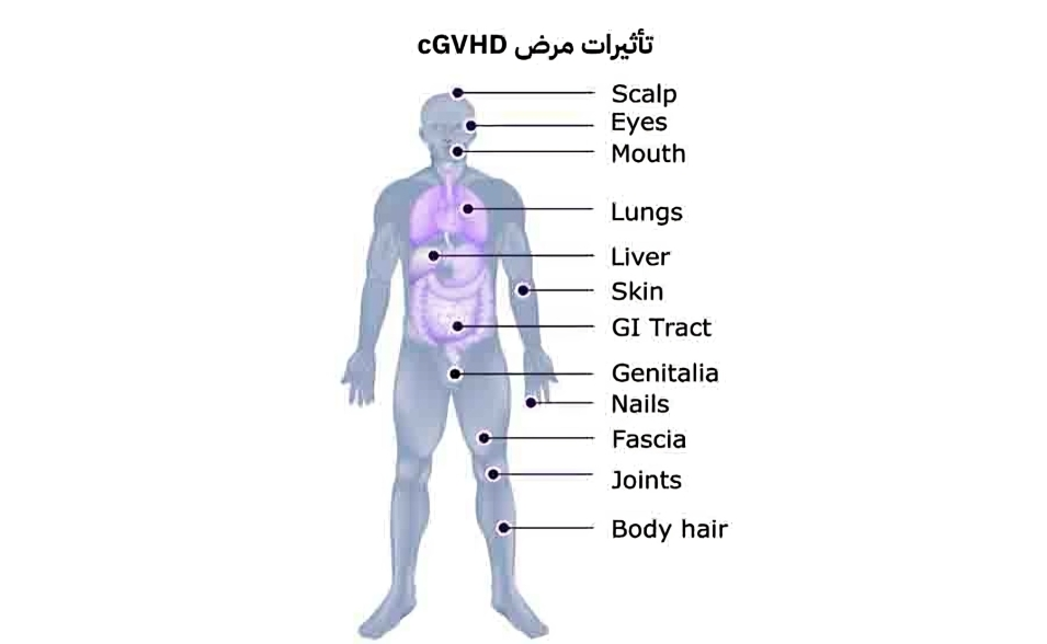 في اليوم العالمي لمرضى الطرد العكسي ضد النخاع.. ماذا بعد زراعة النخاع العظمي؟ (تقرير)